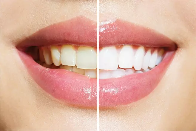 Teeth Whitening